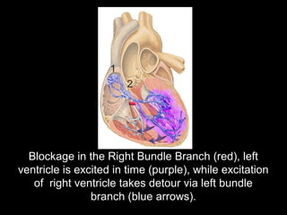 Blockage in the Right Bundle Branch (red), left
ventricle is excited in time (purple), while excitation
of right ventricle takes detour via left bundle
branch (blue arrows).
 