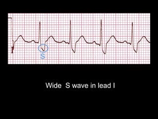 Wide S wave in lead I
 