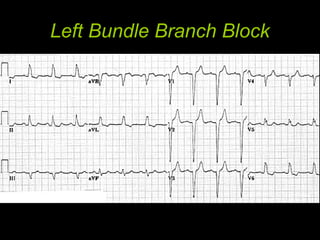 Left Bundle Branch Block
 