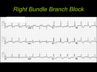Right Bundle Branch Block
 