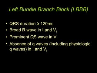 Left Bundle Branch Block (LBBB)

• QRS duration ≥ 120ms
• Broad R wave in I and V6
• Prominent QS wave in V1
• Absence of q waves (including physiologic
  q waves) in I and V6
 