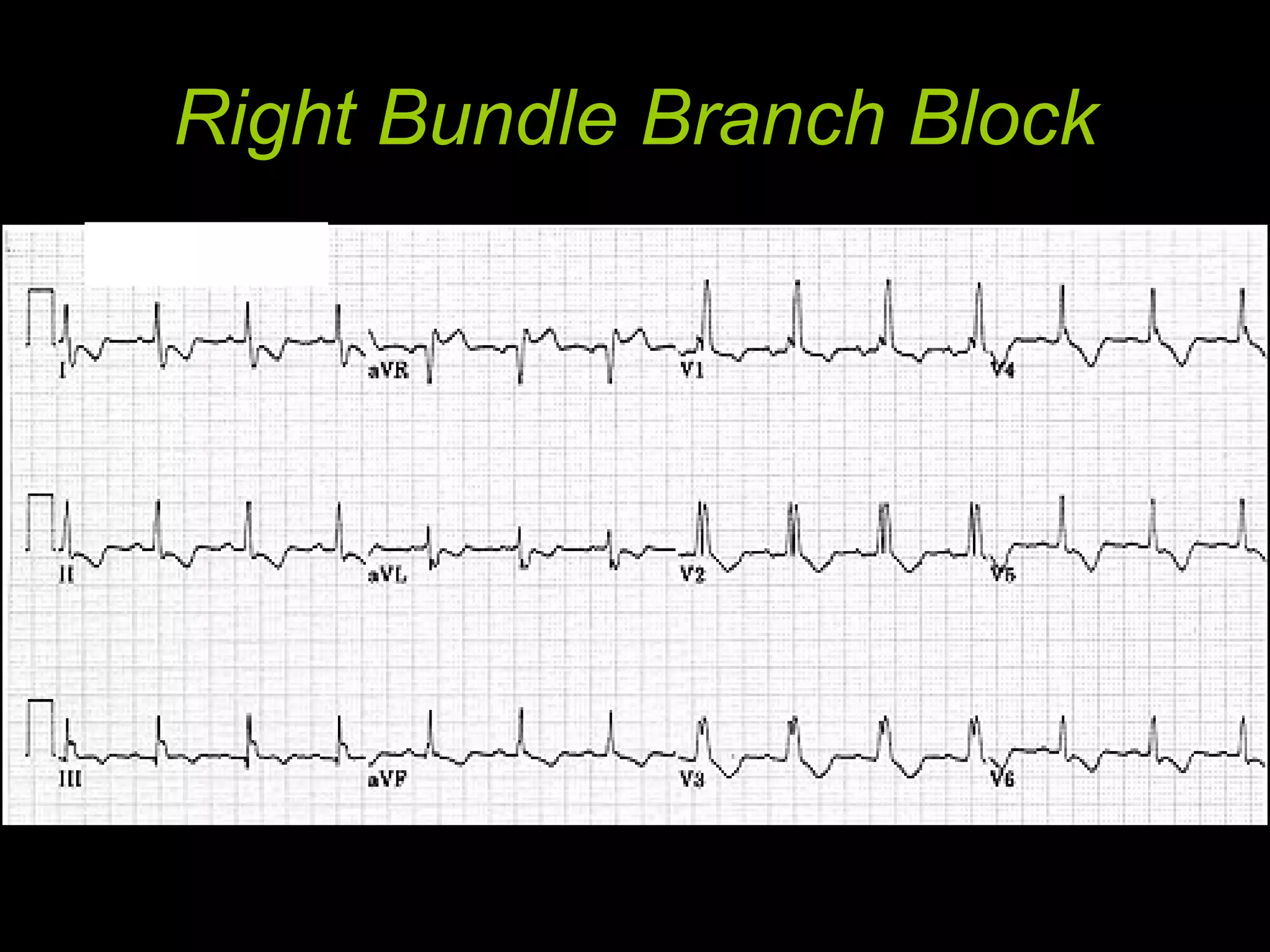 Bundle Branch Blocks PPT bundle-branch-blocks-ppt