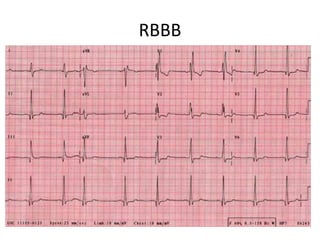 RBBB
 