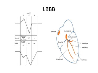 LBBB
 