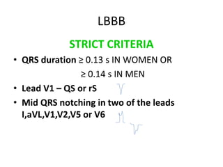 STRICT CRITERIA
• QRS duration ≥ 0.13 s IN WOMEN OR
≥ 0.14 s IN MEN
• Lead V1 – QS or rS
• Mid QRS notching in two of the leads
I,aVL,V1,V2,V5 or V6
LBBB
 