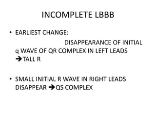 INCOMPLETE LBBB
• EARLIEST CHANGE:
DISAPPEARANCE OF INITIAL
q WAVE OF QR COMPLEX IN LEFT LEADS
TALL R
• SMALL INITIAL R WAVE IN RIGHT LEADS
DISAPPEAR QS COMPLEX
 