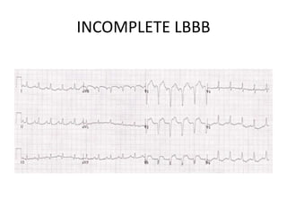 INCOMPLETE LBBB
 