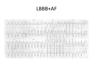 LBBB+AF
 