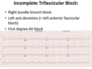 Incomplete Trifascicular Block:
• Right bundle branch block
• Left axis deviation (= left anterior fascicular
block)
• First degree AV block
 