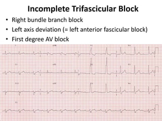 Incomplete Trifascicular Block
• Right bundle branch block
• Left axis deviation (= left anterior fascicular block)
• First degree AV block
•
 