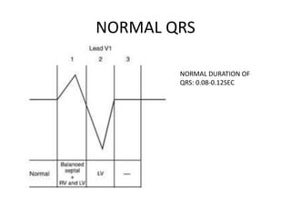 NORMAL QRS
NORMAL DURATION OF
QRS: 0.08-0.12SEC
 