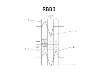 RBBB
R’
s
s
r
 