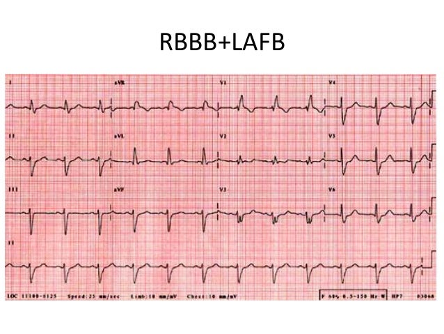 Bundle Branch Blocks