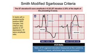 Smith Modified Sgarbossa Criteria
The ST elevation/S wave amplitude ≤−0.25 (ST elevation ≥ 25% of the depth of
the preceding S wave).
In leads with a
predominantly
positive QRS
complex, this
criterion also
applies to ST
depression / R
wave amplitude
ratio.
 
