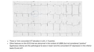 ● There is 1mm concordant ST elevation in aVL (= 5 points).
● Other features on this ECG that are abnormal in the context of LBBB (but not considered “positive”
Sgarbossa criteria) are the pathological Q wave in lead I and the concordant ST depression in the inferior
leads III and aVF.
 