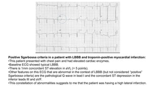 Positive Sgarbossa criteria in a patient with LBBB and troponin-positive myocardial infarction:
•This patient presented with chest pain and had elevated cardiac enzymes.
•Baseline ECG showed typical LBBB.
•There is 1mm concordant ST elevation in aVL (= 5 points).
•Other features on this ECG that are abnormal in the context of LBBB (but not considered “positive”
Sgarbossa criteria) are the pathological Q wave in lead I and the concordant ST depression in the
inferior leads III and aVF.
•This constellation of abnormalities suggests to me that the patient was having a high lateral infarction.
 