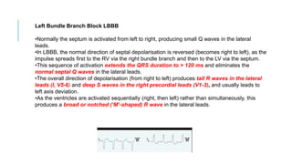 Left Bundle Branch Block LBBB
•Normally the septum is activated from left to right, producing small Q waves in the lateral
leads.
•In LBBB, the normal direction of septal depolarisation is reversed (becomes right to left), as the
impulse spreads first to the RV via the right bundle branch and then to the LV via the septum.
•This sequence of activation extends the QRS duration to > 120 ms and eliminates the
normal septal Q waves in the lateral leads.
•The overall direction of depolarisation (from right to left) produces tall R waves in the lateral
leads (I, V5-6) and deep S waves in the right precordial leads (V1-3), and usually leads to
left axis deviation.
•As the ventricles are activated sequentially (right, then left) rather than simultaneously, this
produces a broad or notched (‘M’-shaped) R wave in the lateral leads.
 