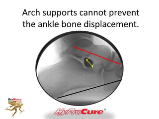 Arch supports cannot prevent
the ankle bone displacement.
 