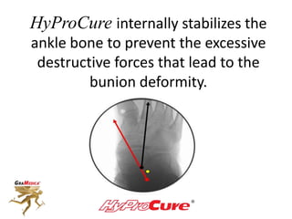 HyProCure internally stabilizes the
ankle bone to prevent the excessive
destructive forces that lead to the
bunion deformity.
 
