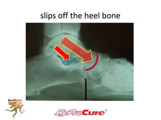 slips off the heel bone
 