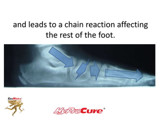 and leads to a chain reaction affecting
the rest of the foot.
 