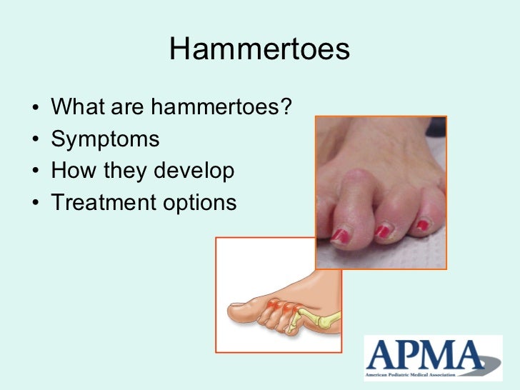 Bunions and Hammertoes Symptoms and Treatment