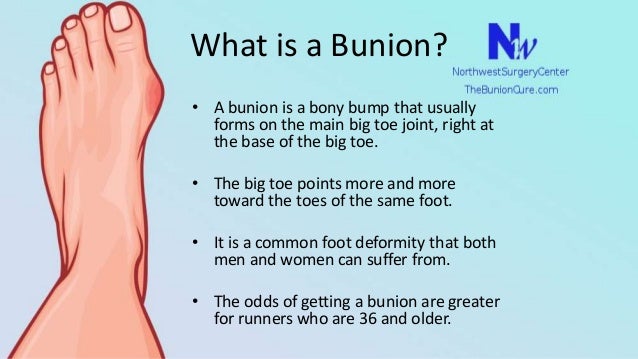 Bunion Surgery Options Today