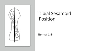 Tibial Sesamoid
Position
Normal 1-3
 