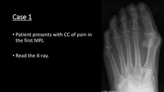Case 1
• Patient presents with CC of pain in
the first MPJ.
• Read the X-ray.
 