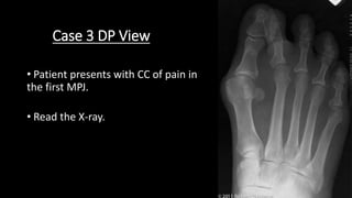 Case 3 DP View
• Patient presents with CC of pain in
the first MPJ.
• Read the X-ray.
 