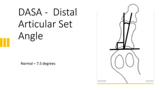 DASA - Distal
Articular Set
Angle
Normal – 7.5 degrees
 