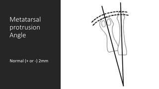 Metatarsal
protrusion
Angle
Normal (+ or -) 2mm
 
