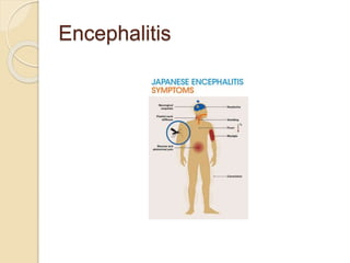 Encephalitis
 