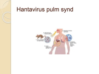 Hantavirus pulm synd
 