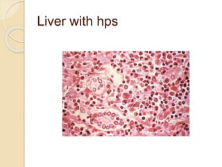 Liver with hps
 
