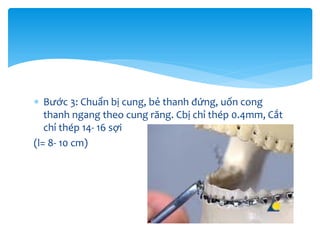  Bước 3: Chuẩn bị cung, bẻ thanh đứng, uốn cong
thanh ngang theo cung răng. Cbị chỉ thép 0.4mm, Cắt
chỉ thép 14- 16 sợi
(l= 8- 10 cm)

 