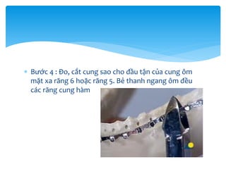  Bước 4 : Đo, cắt cung sao cho đầu tận của cung ôm
mặt xa răng 6 hoặc răng 5. Bẻ thanh ngang ôm đều
các răng cung hàm

 
