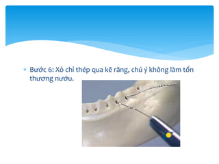  Bước 6: Xỏ chỉ thép qua kẽ răng, chú ý không làm tổn
thương nướu.

 