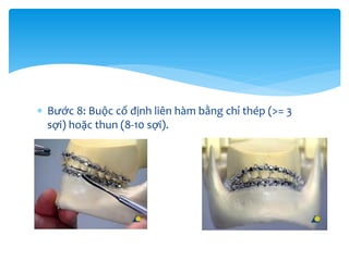  Bước 8: Buộc cố định liên hàm bằng chỉ thép (>= 3
sợi) hoặc thun (8-10 sợi).

 