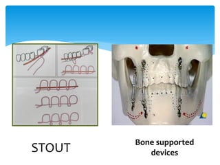 STOUT

Bone supported
devices

 