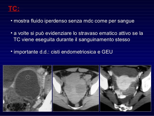 Corpo Luteo Emorragico Si Riassorbe