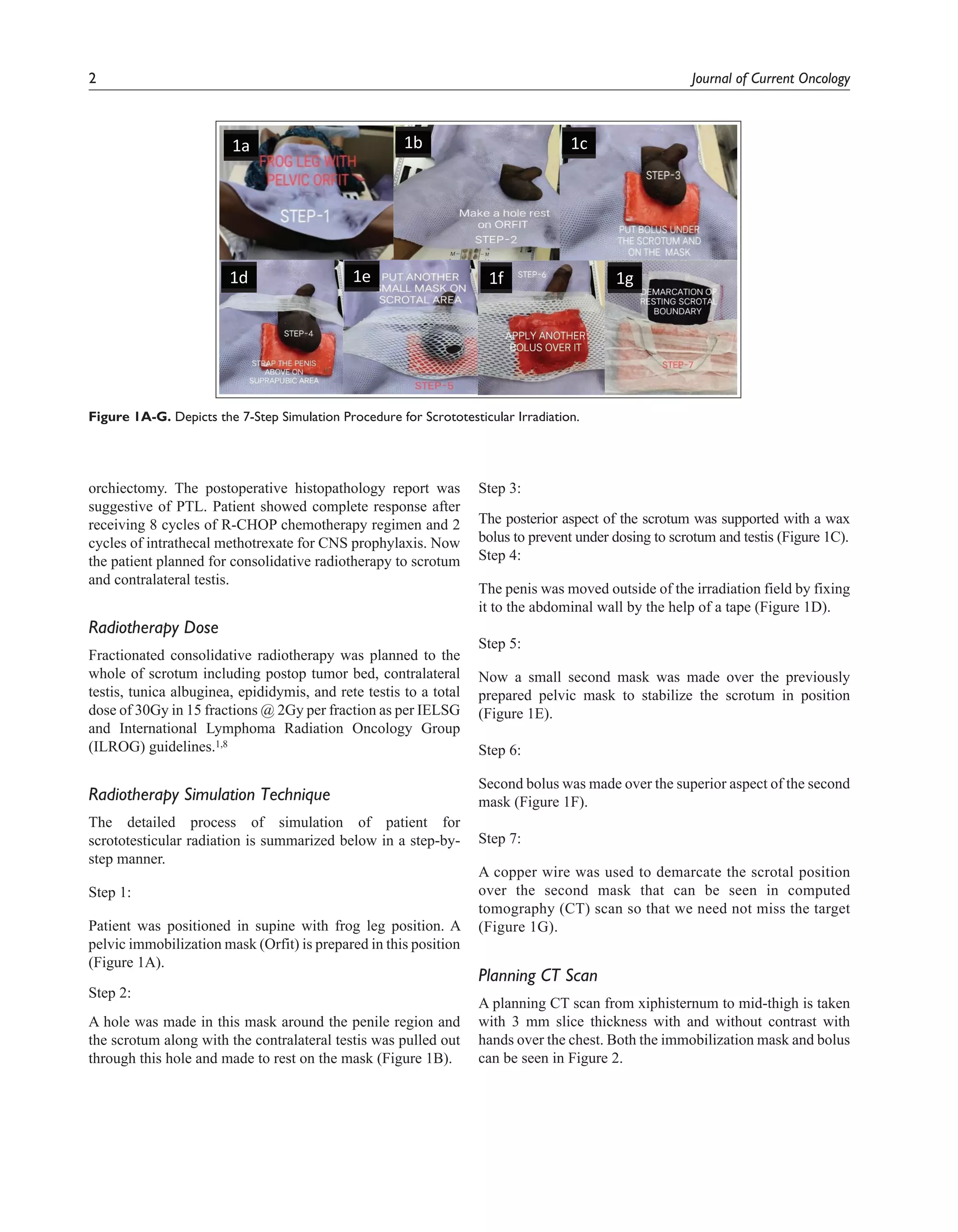 2 Journal of Current Oncology
orchiectomy. The postoperative histopathology report was
suggestive of PTL. Patient showed complete response after
receiving 8 cycles of R-CHOP chemotherapy regimen and 2
cycles of intrathecal methotrexate for CNS prophylaxis. Now
the patient planned for consolidative radiotherapy to scrotum
and contralateral testis.
Radiotherapy Dose
Fractionated consolidative radiotherapy was planned to the
whole of scrotum including postop tumor bed, contralateral
testis, tunica albuginea, epididymis, and rete testis to a total
dose of 30Gy in 15 fractions @ 2Gy per fraction as per IELSG
and International Lymphoma Radiation Oncology Group
(ILROG) guidelines.1,8
Radiotherapy Simulation Technique
The detailed process of simulation of patient for
scrototesticular radiation is summarized below in a step-by-
step manner.
Step 1:
Patient was positioned in supine with frog leg position. A
pelvic immobilization mask (Orfit) is prepared in this position
(Figure 1A).
Step 2:
A hole was made in this mask around the penile region and
the scrotum along with the contralateral testis was pulled out
through this hole and made to rest on the mask (Figure 1B).
Step 3:
The posterior aspect of the scrotum was supported with a wax
bolus to prevent under dosing to scrotum and testis (Figure 1C).
Step 4:
The penis was moved outside of the irradiation field by fixing
it to the abdominal wall by the help of a tape (Figure 1D).
Step 5:
Now a small second mask was made over the previously
prepared pelvic mask to stabilize the scrotum in position
(Figure 1E).
Step 6:
Second bolus was made over the superior aspect of the second
mask (Figure 1F).
Step 7:
A copper wire was used to demarcate the scrotal position
over the second mask that can be seen in computed
tomography (CT) scan so that we need not miss the target
(Figure 1G).
Planning CT Scan
A planning CT scan from xiphisternum to mid-thigh is taken
with 3 mm slice thickness with and without contrast with
hands over the chest. Both the immobilization mask and bolus
can be seen in Figure 2.
1a
1g
1f
1e
1c
1b
1d
Figure 1A-G. Depicts the 7-Step Simulation Procedure for Scrototesticular Irradiation.
 