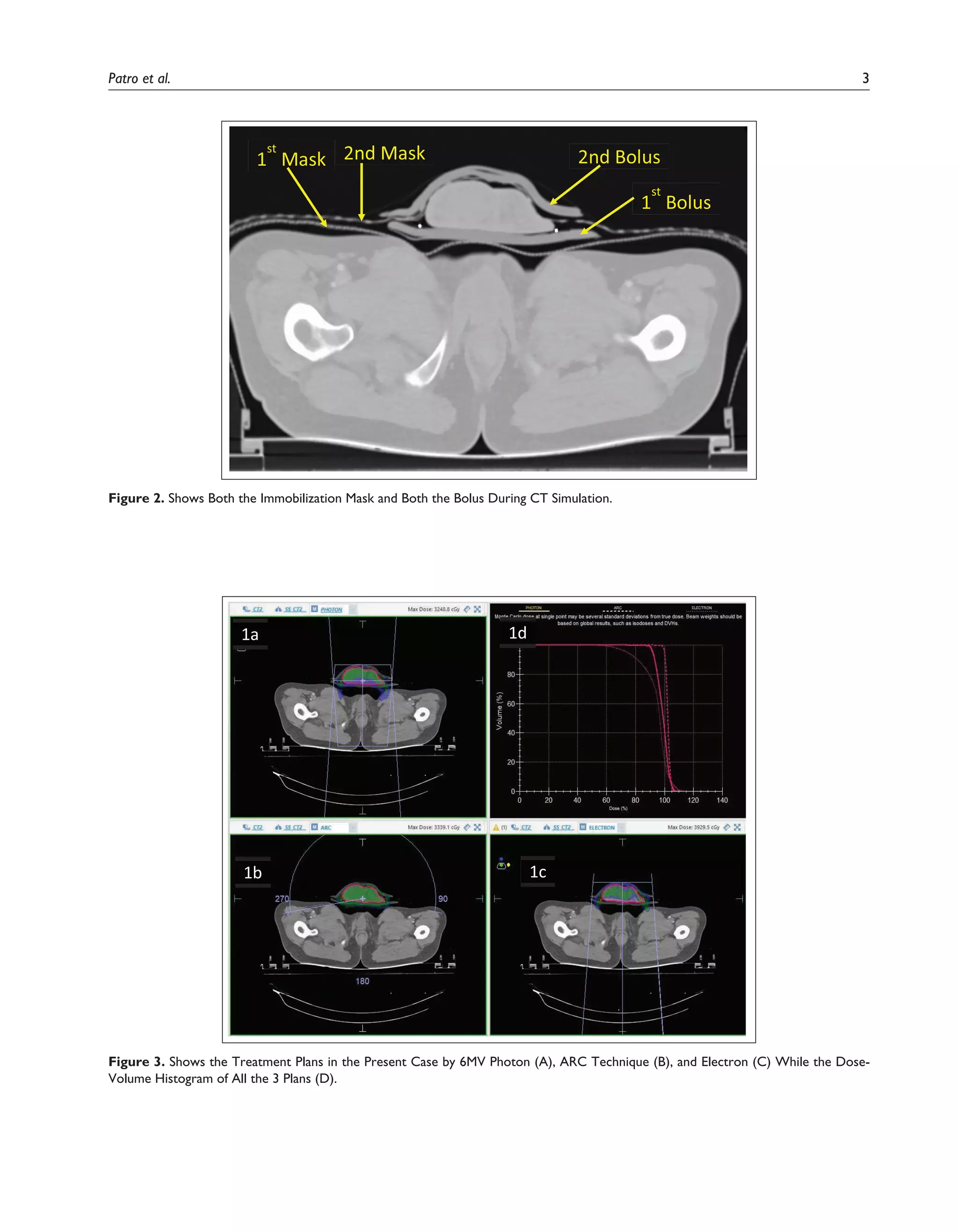 Patro et al. 3
1
st
Mask 2nd Mask
1
st
Bolus
2nd Bolus
Figure 2. Shows Both the Immobilization Mask and Both the Bolus During CT Simulation.
1a
1c
1b
1d
Figure 3. Shows the Treatment Plans in the Present Case by 6MV Photon (A), ARC Technique (B), and Electron (C) While the Dose-
Volume Histogram of All the 3 Plans (D).
 