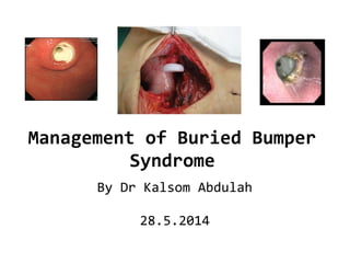 Management of Buried Bumper
Syndrome
By Dr Kalsom Abdulah
28.5.2014
 