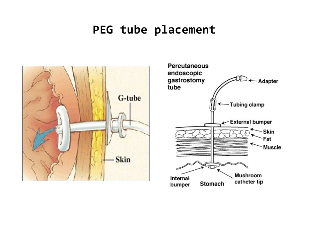 Buried bumper syndrome