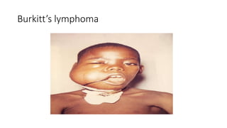 Burkitt’s lymphoma
 