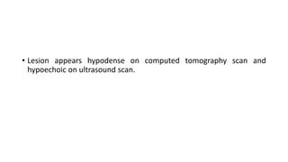 • Lesion appears hypodense on computed tomography scan and
hypoechoic on ultrasound scan.
 