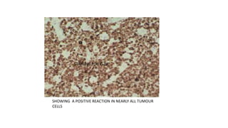 SHOWING A POSITIVE REACTION IN NEARLY ALL TUMOUR
CELLS
STAINING FOR Ki-67
 