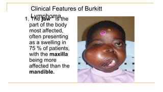 Clinical Features of Burkitt
Lymphoma
1. The jaw * is the
part of the body
most affected,
often presenting
as a swelling in
75 % of patients,
with the maxilla
being more
affected than the
mandible.
 