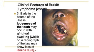 Clinical Features of Burkitt
Lymphoma [contd].
 3. Early in the
course of the
illness,
looseness of
the teeth may
occur, with
gingival
swelling [which
on a radiograph
of the jaw may
show loss of
lamina dura].-
 